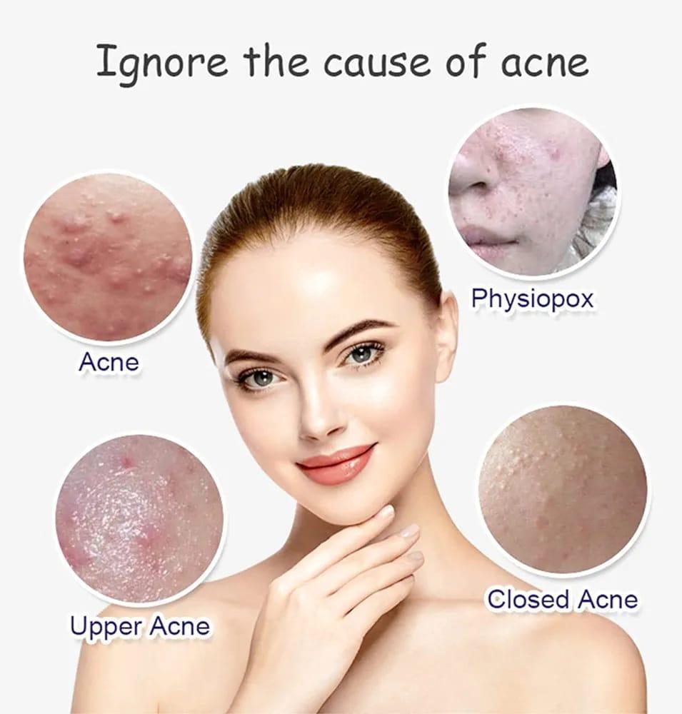 Anti Acne Whitening Facial Serum