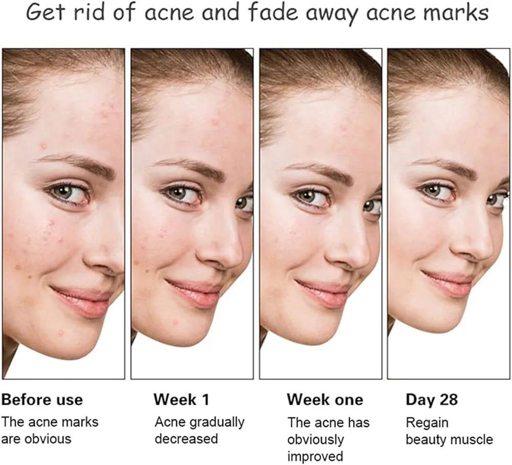 Anti Acne Whitening Facial Serum