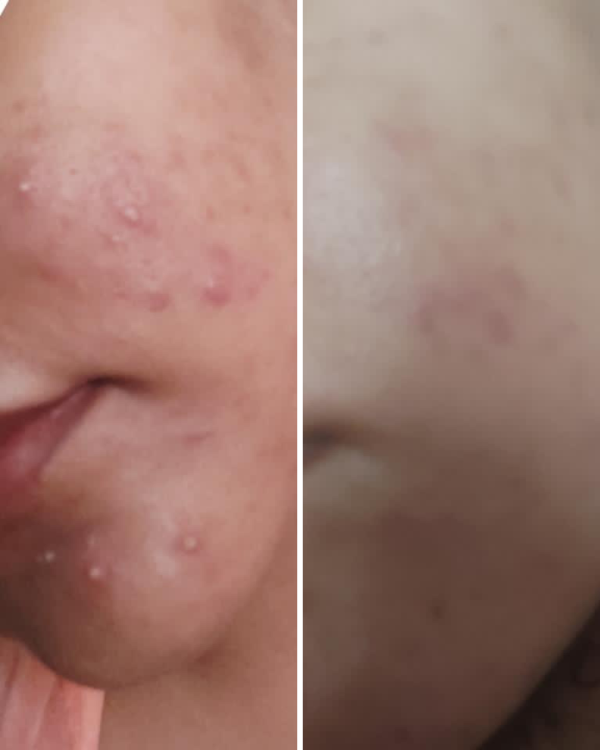 Nirvana Botanics Vitamin C + E Serum – Ml 15 | Anti Acne & Glowing Serum Vitamin C + E