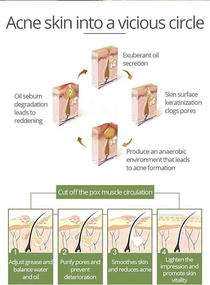 Anti Acne Whitening Facial Serum